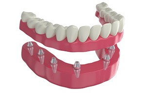 3D render of implant dentures